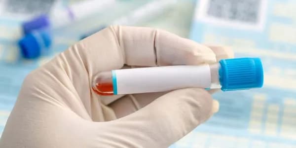 Badanie FSH u mężczyzn: klucz do zrozumienia niepłodności i hormonów