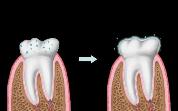 Objawy niedoboru fluoru: jak rozpoznać zagrożenie dla zdrowia zębów