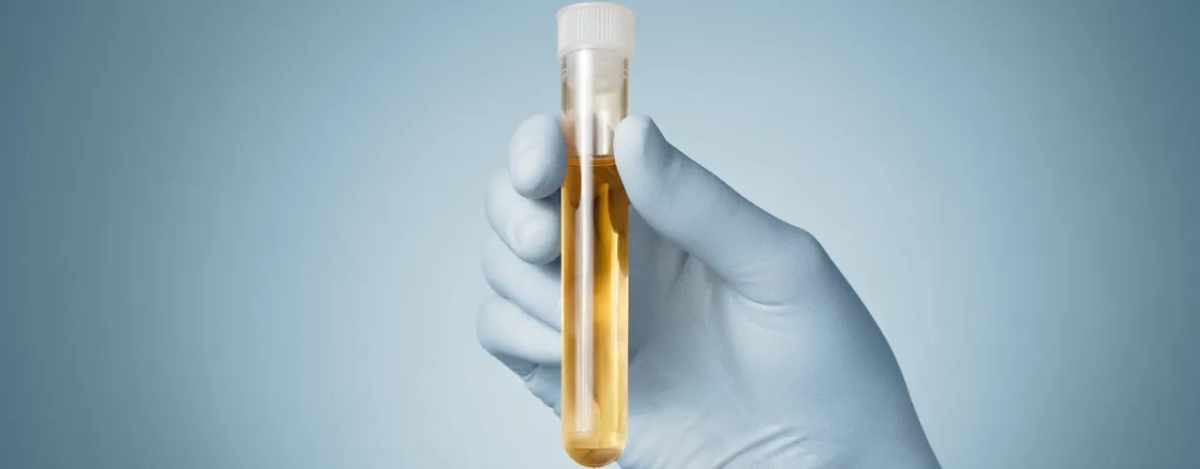 Gdzie trzymać mocz przed badaniem, aby uniknąć błędów w wynikach?