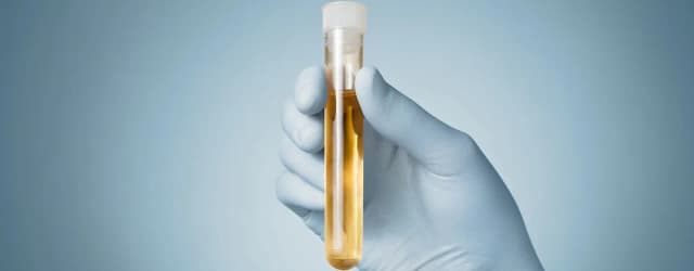 Gdzie trzymać mocz przed badaniem, aby uniknąć błędów w wynikach? Gdzie trzymać mocz przed badaniem, aby uniknąć błędów w wynikach?