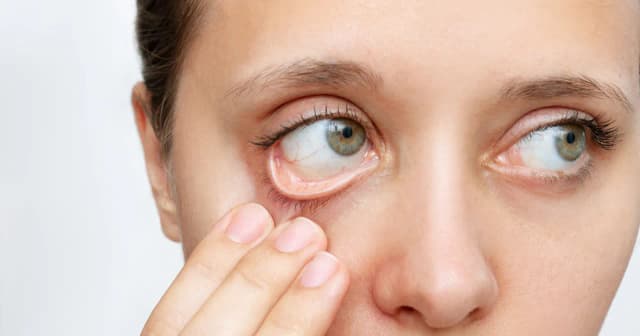 Objawy niedokrwistości z niedoboru żelaza – nie ignoruj tych sygnałów Objawy niedokrwistości z niedoboru żelaza – nie ignoruj tych sygnałów