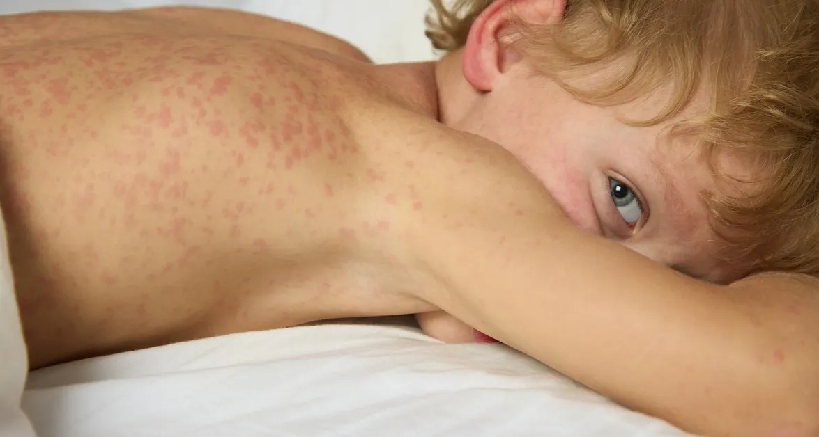 Skutki uboczne Vines: co musisz wiedzieć o działaniach niepożądanych