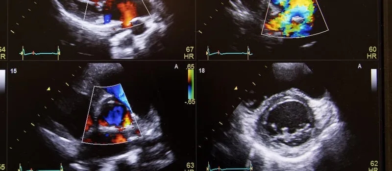 Badanie dopplerowskie na czym polega? Poznaj jego zalety i przebieg