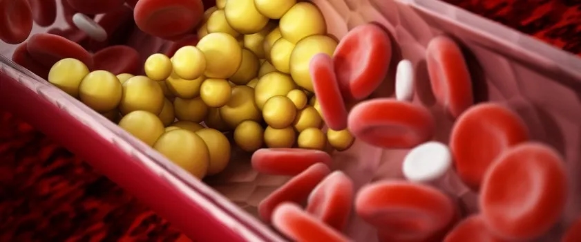 Podwyższony poziom trójglicerydów przyczyny i jak je zredukować