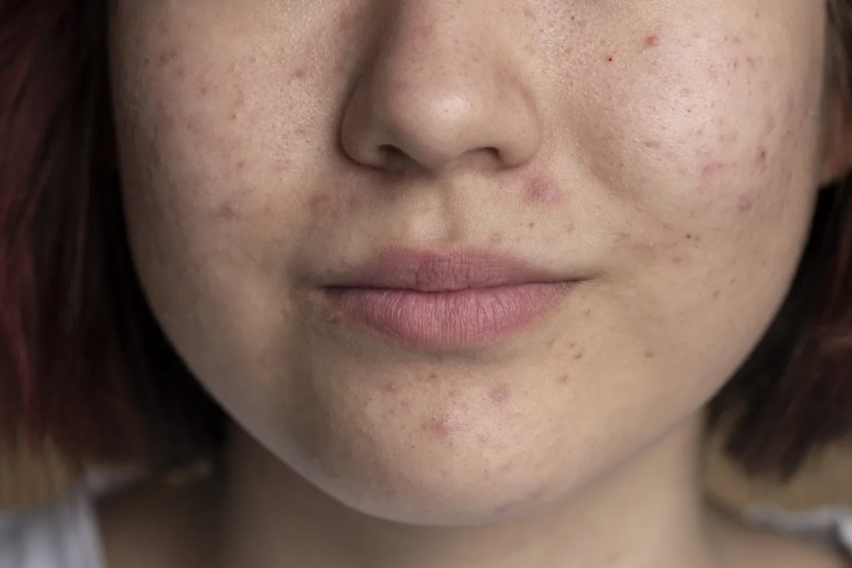 Niedobór witaminy A objawy skórne – jak uniknąć problemów ze skórą