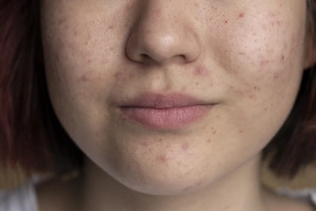 Niedobór witaminy A objawy skórne – jak uniknąć problemów ze skórą