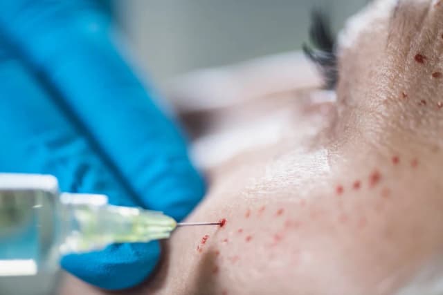 Skutki uboczne wampirzego liftingu - co musisz wiedzieć przed zabiegiem