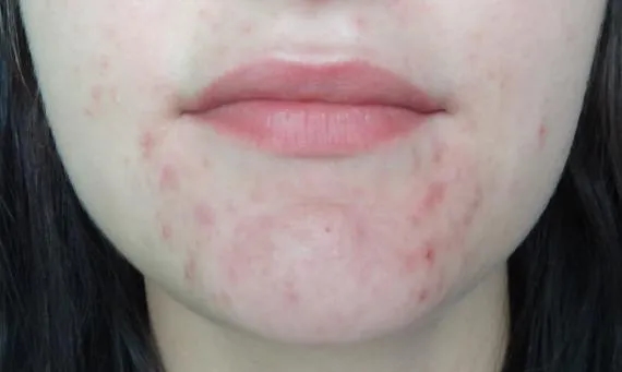 Skutki uboczne po odstawieniu Tetralysal – co musisz wiedzieć?