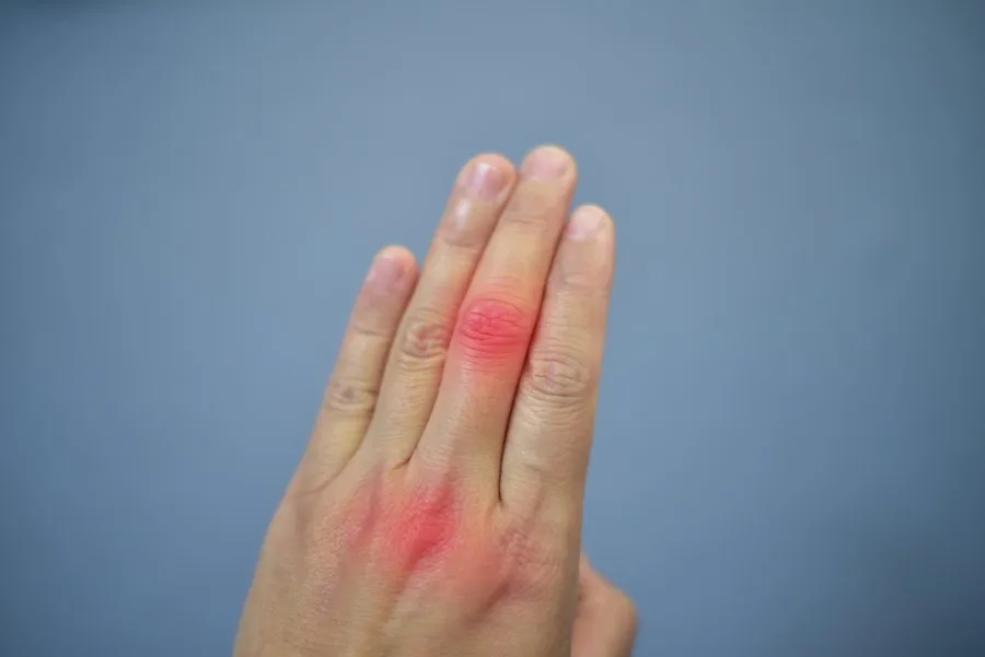 Podwyższony poziom kwasu moczowego: przyczyny, objawy i leczenie