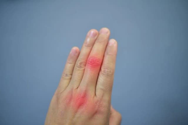 Podwyższony poziom kwasu moczowego: przyczyny, objawy i leczenie