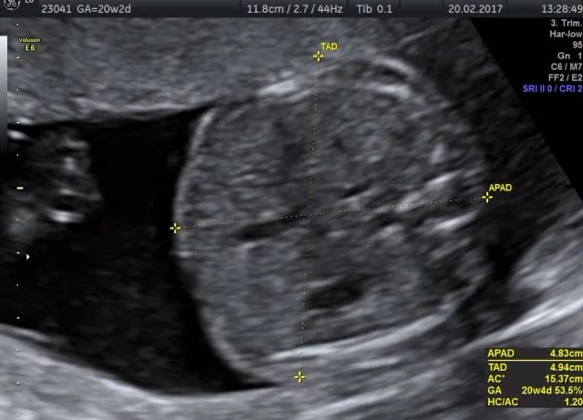 Jak wyglądają badania połówkowe? Co musisz wiedzieć przed USG